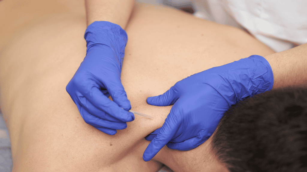 Lucus Leung performing dry needling treatment on a patient at Alpine Rehab Gold Coast