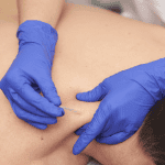 Lucus Leung performing dry needling treatment on a patient at Alpine Rehab Gold Coast